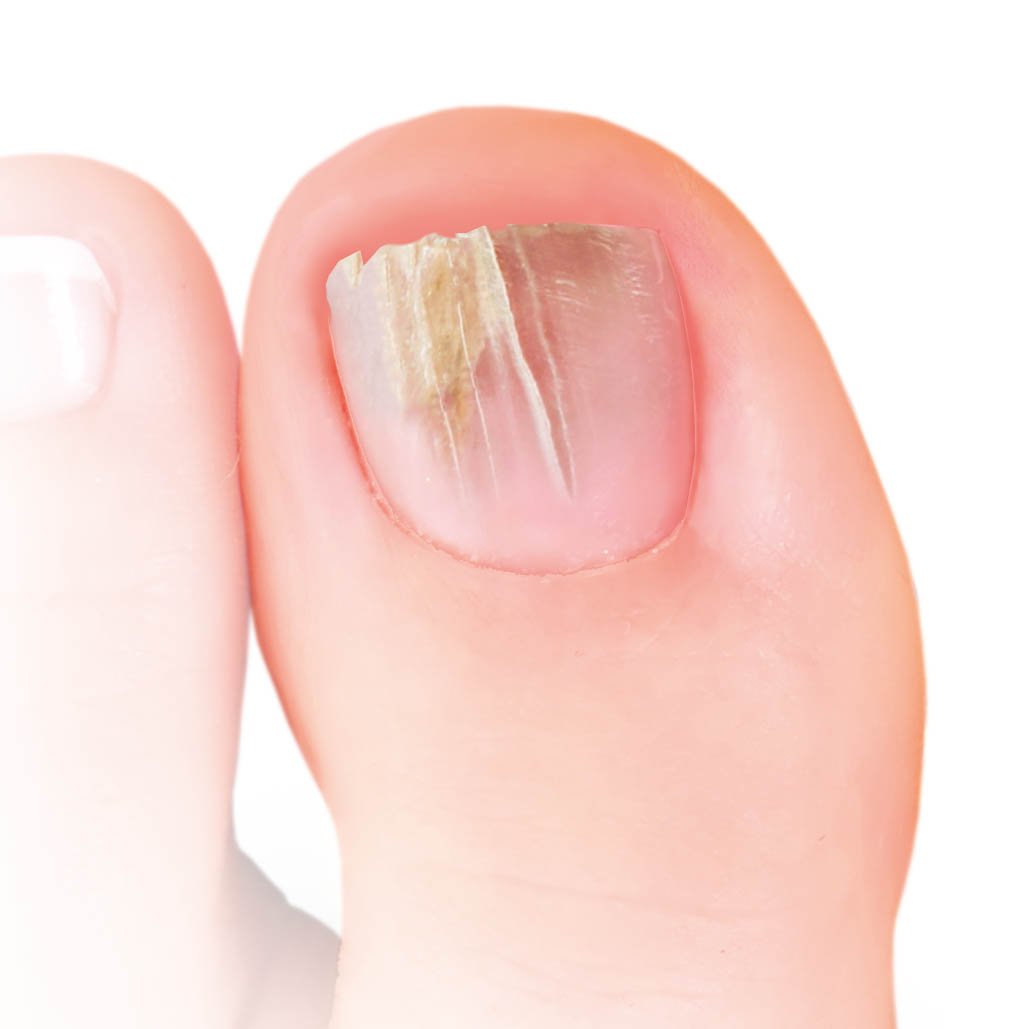 Nailner-toe-box-cracked