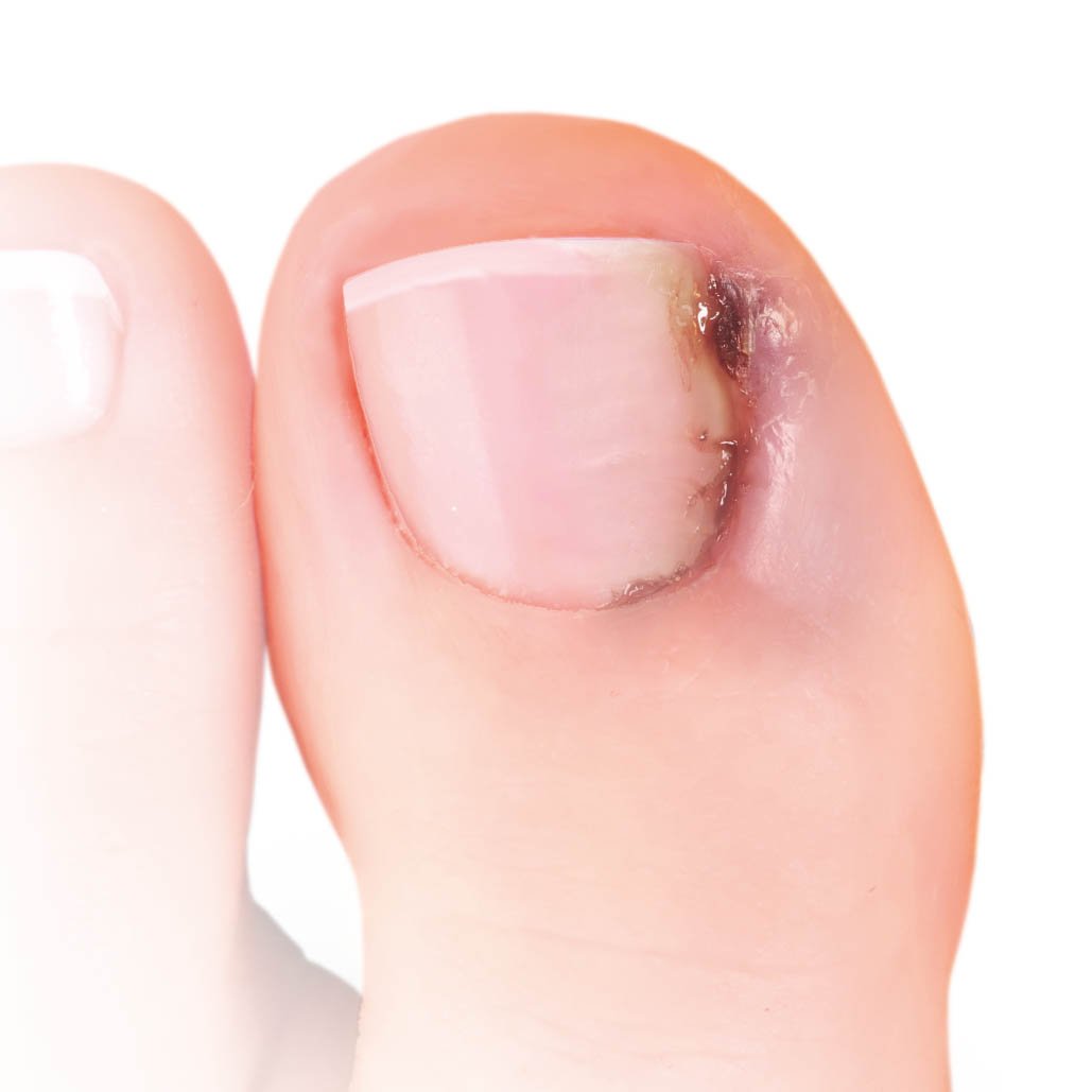 Nailner-toe-box-painful